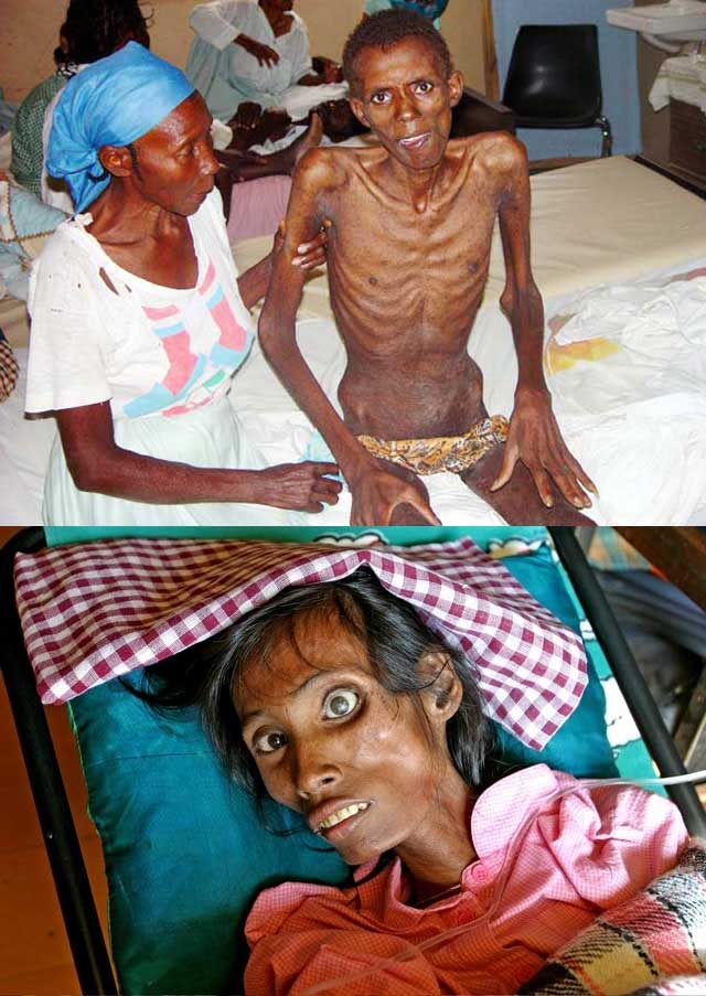 این دو تصویر قربانیان ایدز را نشان می دهد. این بیماری رفته رفته بدن را نرم، لاغر، و آب می کند تا آنجا که پوستی بیشتر بر تن نمی ماند.